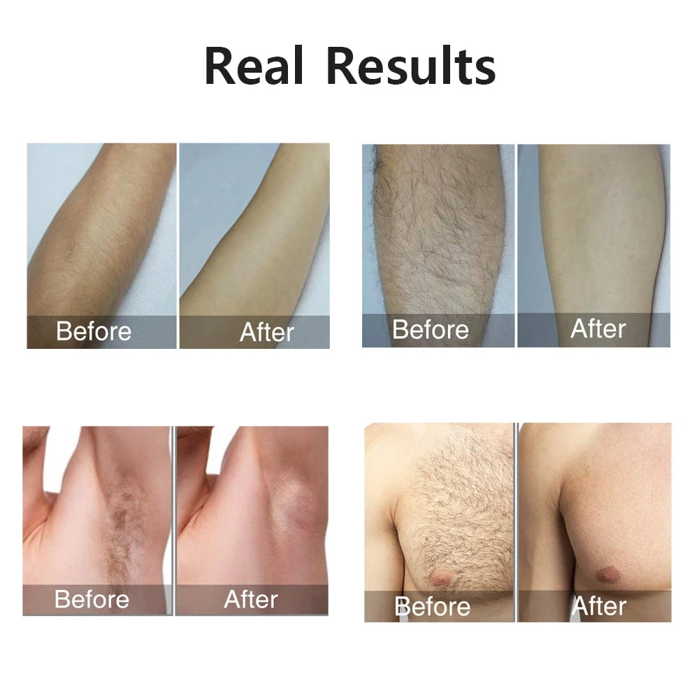 Sistema de depilação IPL para mulheres 990000 flashes Dispositivo depilador a laser permanente indolor para corpo, biquíni e removedor de pelos faciais em